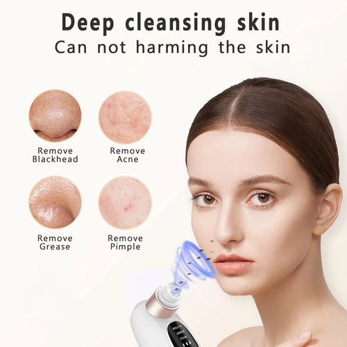 Velari™ Deep Pore Blackhead Remover